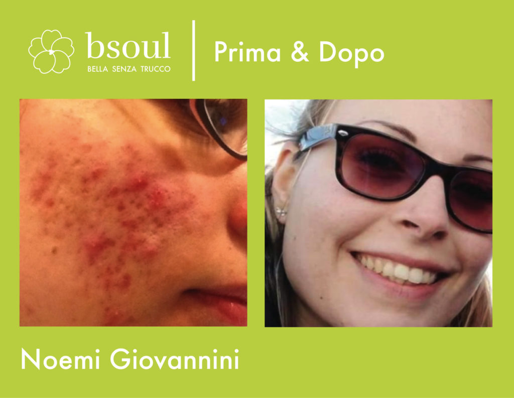 bsoul cosmetici naturali prima e dopo acne