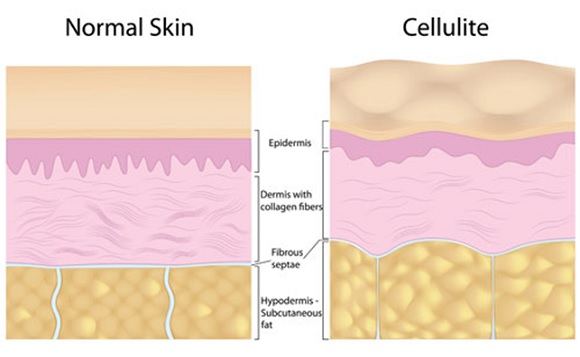 Adiposità localizzata e cellulite, come eliminarle - Skincare blog bSoul